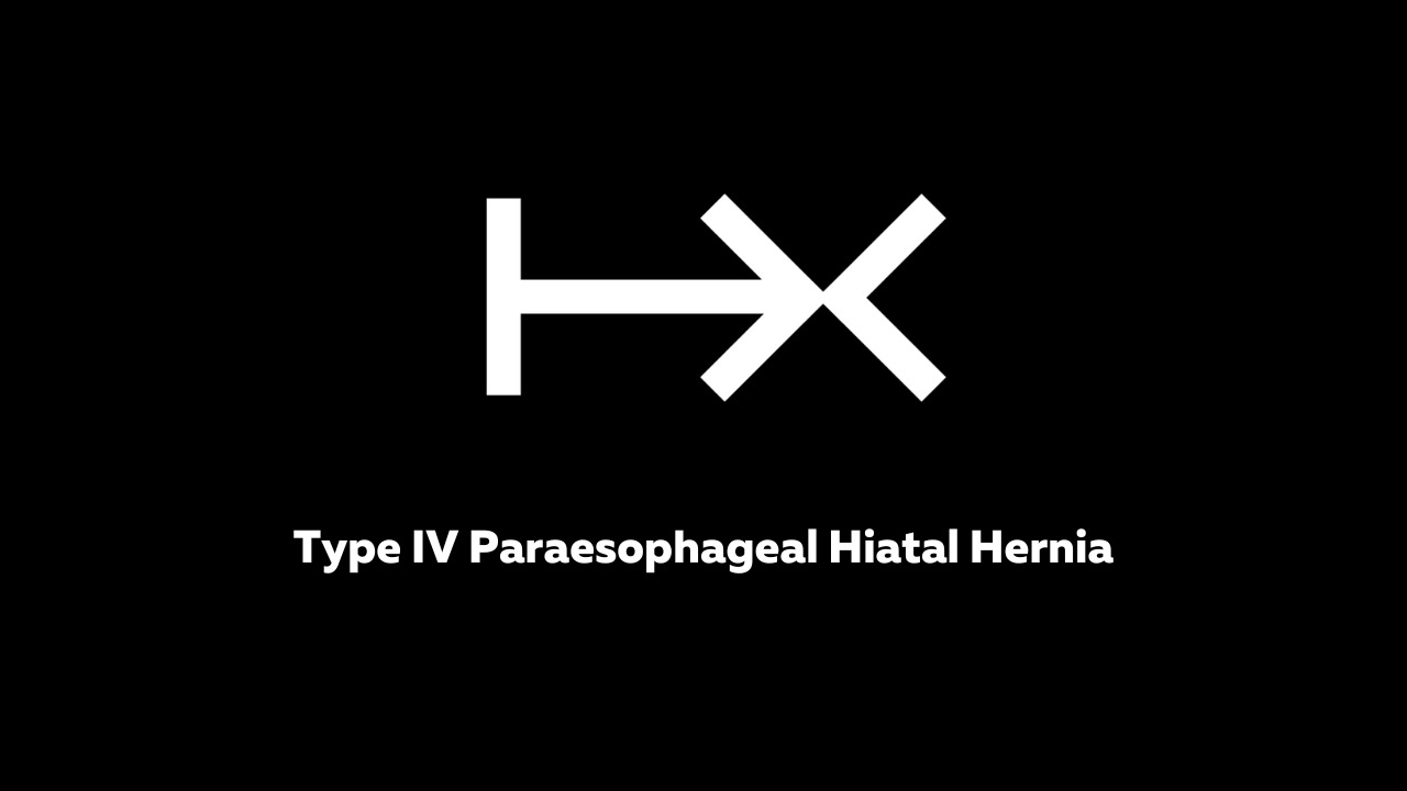 Type IV Paraesophageal Hiatal Hernia with HandX™ | Human Xtensions